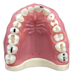 Manequim de Treinamento Odontológico (Cárie)